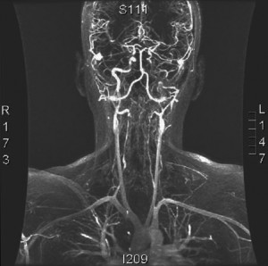 "Angio MR" by Germain Orphanet Journal of Rare Diseases 2007 2:32 doi:10.1186/1750-1172-2-32. Licensed under CC BY 2.0 via Wikimedia Commons - http://commons.wikimedia.org/wiki/File:Angio_MR.jpg#mediaviewer/File:Angio_MR.jpg